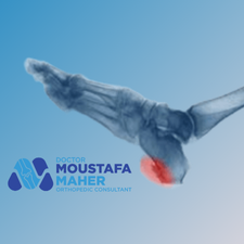 علاج العظمة الشوكية في الكعب