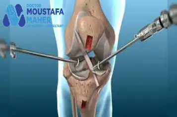 تكلفة عملية غضروف الركبةبالمنظار في مصر