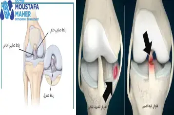 الفرق بين قطع وتمزق الرباط الصليبي