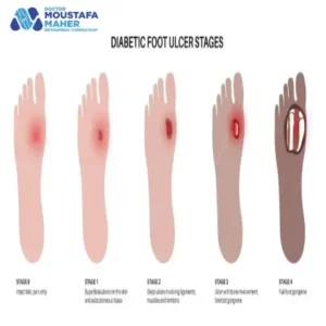 غرغرينا القدم بالصور